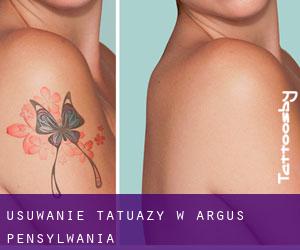 Usuwanie tatuaży w Argus (Pensylwania)