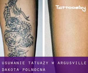 Usuwanie tatuaży w Argusville (Dakota Północna)