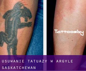 Usuwanie tatuaży w Argyle (Saskatchewan)