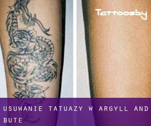 Usuwanie tatuaży w Argyll and Bute