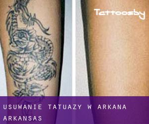 Usuwanie tatuaży w Arkana (Arkansas)