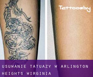 Usuwanie tatuaży w Arlington Heights (Wirginia)