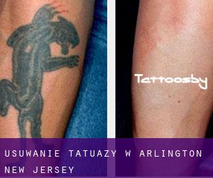 Usuwanie tatuaży w Arlington (New Jersey)