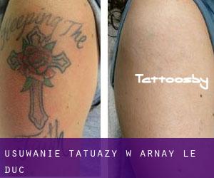 Usuwanie tatuaży w Arnay-le-Duc