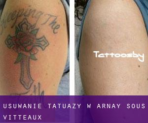 Usuwanie tatuaży w Arnay-sous-Vitteaux