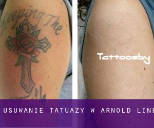 Usuwanie tatuaży w Arnold Line