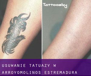 Usuwanie tatuaży w Arroyomolinos (Estremadura)