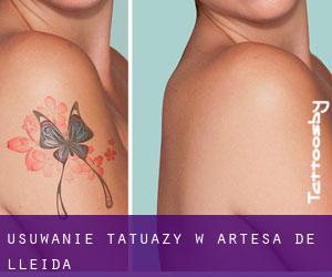 Usuwanie tatuaży w Artesa de Lleida