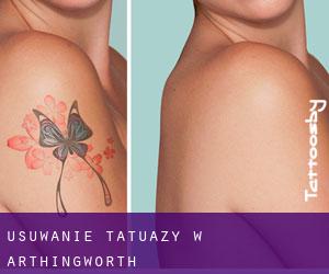 Usuwanie tatuaży w Arthingworth