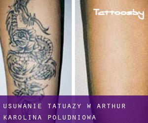 Usuwanie tatuaży w Arthur (Karolina Południowa)