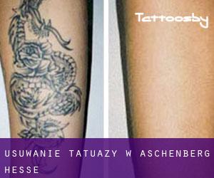 Usuwanie tatuaży w Aschenberg (Hesse)