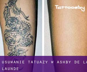 Usuwanie tatuaży w Ashby de la Launde