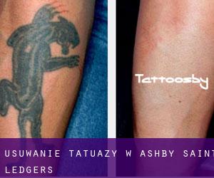 Usuwanie tatuaży w Ashby Saint Ledgers