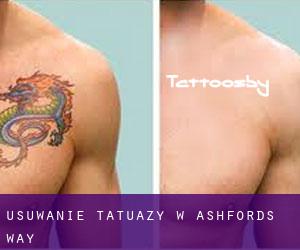 Usuwanie tatuaży w Ashfords Way