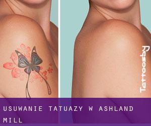 Usuwanie tatuaży w Ashland Mill