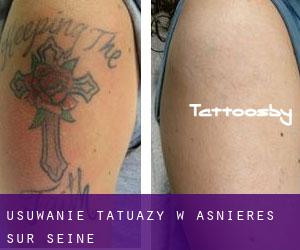 Usuwanie tatuaży w Asnières-sur-Seine