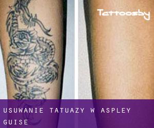 Usuwanie tatuaży w Aspley Guise
