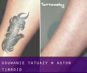 Usuwanie tatuaży w Aston Tirroid