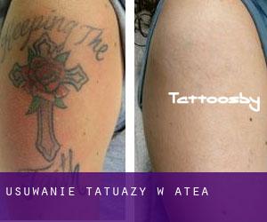 Usuwanie tatuaży w Atea