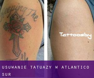 Usuwanie tatuaży w Atlántico Sur