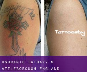 Usuwanie tatuaży w Attleborough (England)