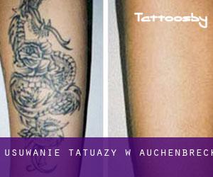 Usuwanie tatuaży w Auchenbreck
