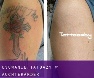 Usuwanie tatuaży w Auchterarder
