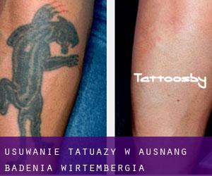 Usuwanie tatuaży w Ausnang (Badenia-Wirtembergia)