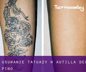 Usuwanie tatuaży w Autilla del Pino