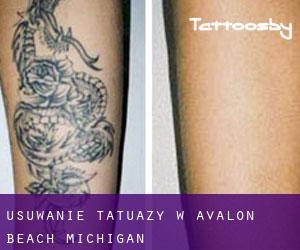 Usuwanie tatuaży w Avalon Beach (Michigan)
