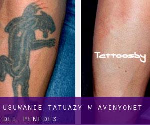 Usuwanie tatuaży w Avinyonet del Penedès