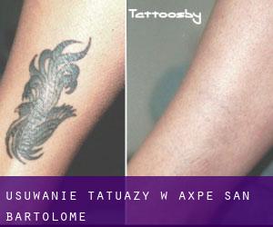 Usuwanie tatuaży w Axpe-San Bartolome