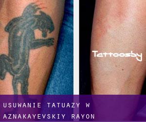 Usuwanie tatuaży w Aznakayevskiy Rayon