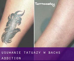 Usuwanie tatuaży w Bachs Addition