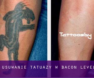 Usuwanie tatuaży w Bacon Level