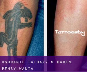 Usuwanie tatuaży w Baden (Pensylwania)