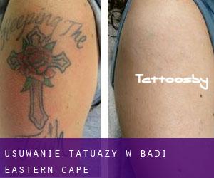 Usuwanie tatuaży w Badi (Eastern Cape)