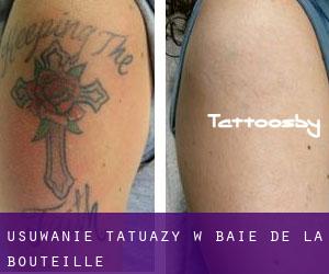 Usuwanie tatuaży w Baie-de-la-Bouteille