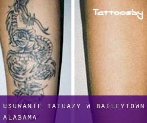 Usuwanie tatuaży w Baileytown (Alabama)