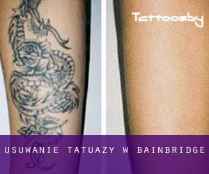 Usuwanie tatuaży w Bainbridge