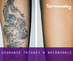 Usuwanie tatuaży w Bairnsdale