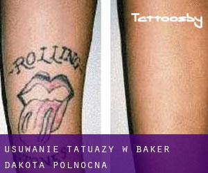Usuwanie tatuaży w Baker (Dakota Północna)