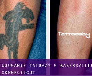 Usuwanie tatuaży w Bakersville (Connecticut)