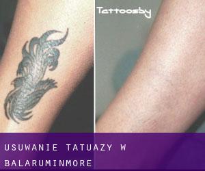 Usuwanie tatuaży w Balaruminmore