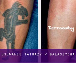 Usuwanie tatuaży w Balaszycha
