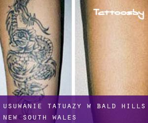 Usuwanie tatuaży w Bald Hills (New South Wales)