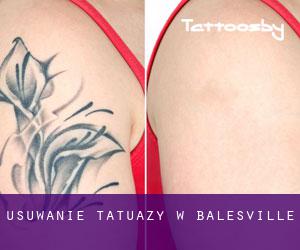 Usuwanie tatuaży w Balesville