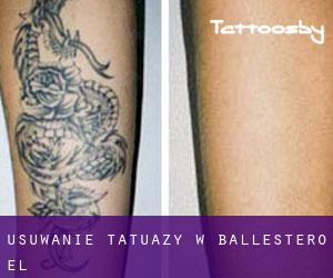 Usuwanie tatuaży w Ballestero (El)