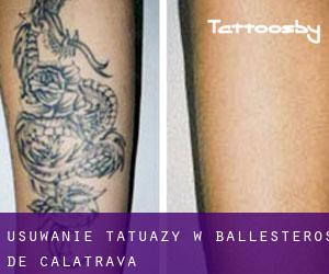 Usuwanie tatuaży w Ballesteros de Calatrava