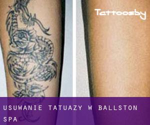 Usuwanie tatuaży w Ballston Spa